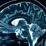 The Long-Term Effects of ADHD on Mental and Physical Health